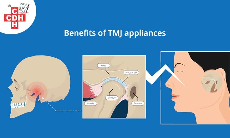 TMJ appliances