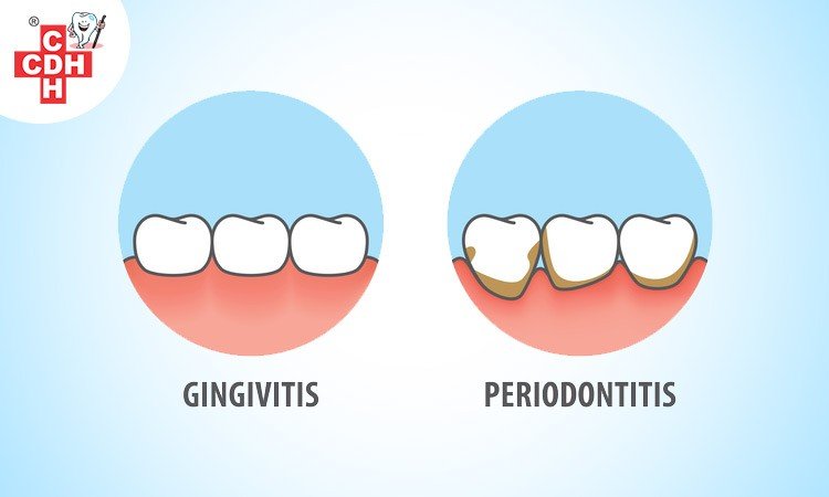 Gingivitis and Periodontitis