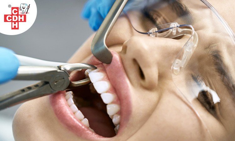 The procedure of Tooth Extraction
