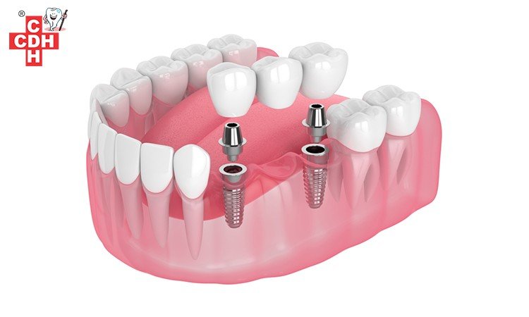 Advantages of Dental Implants over bridges and crowns