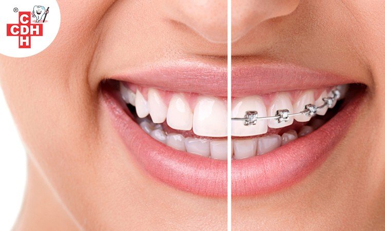 Benefits of an Orthodontic Treatment