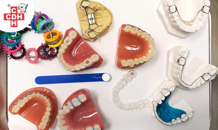Braces Options and Treatments