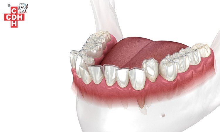 How Invisalign Functions