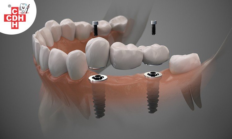 The procedure of Implant-Supported Dentures