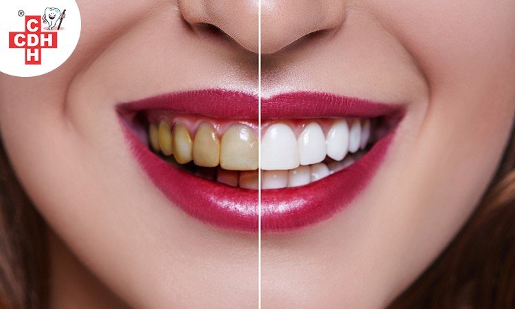 What is Dental Veneers
