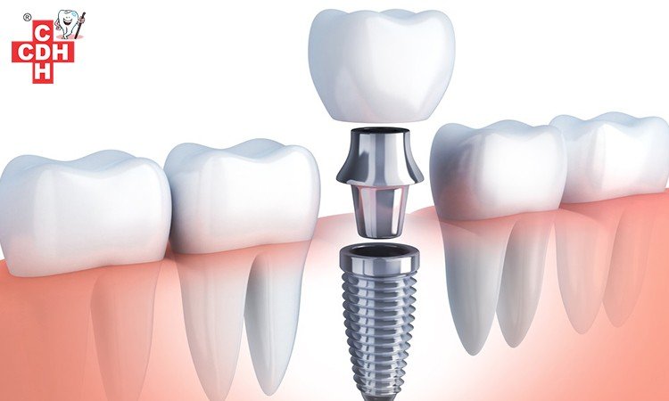 What is Dental Implants