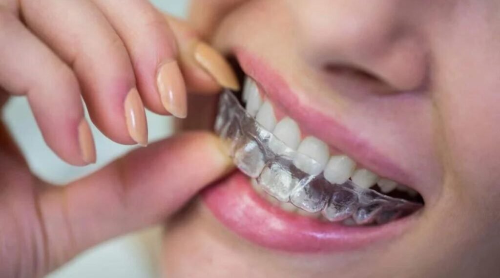 Braces Cost In India Teeth Braces Price In India