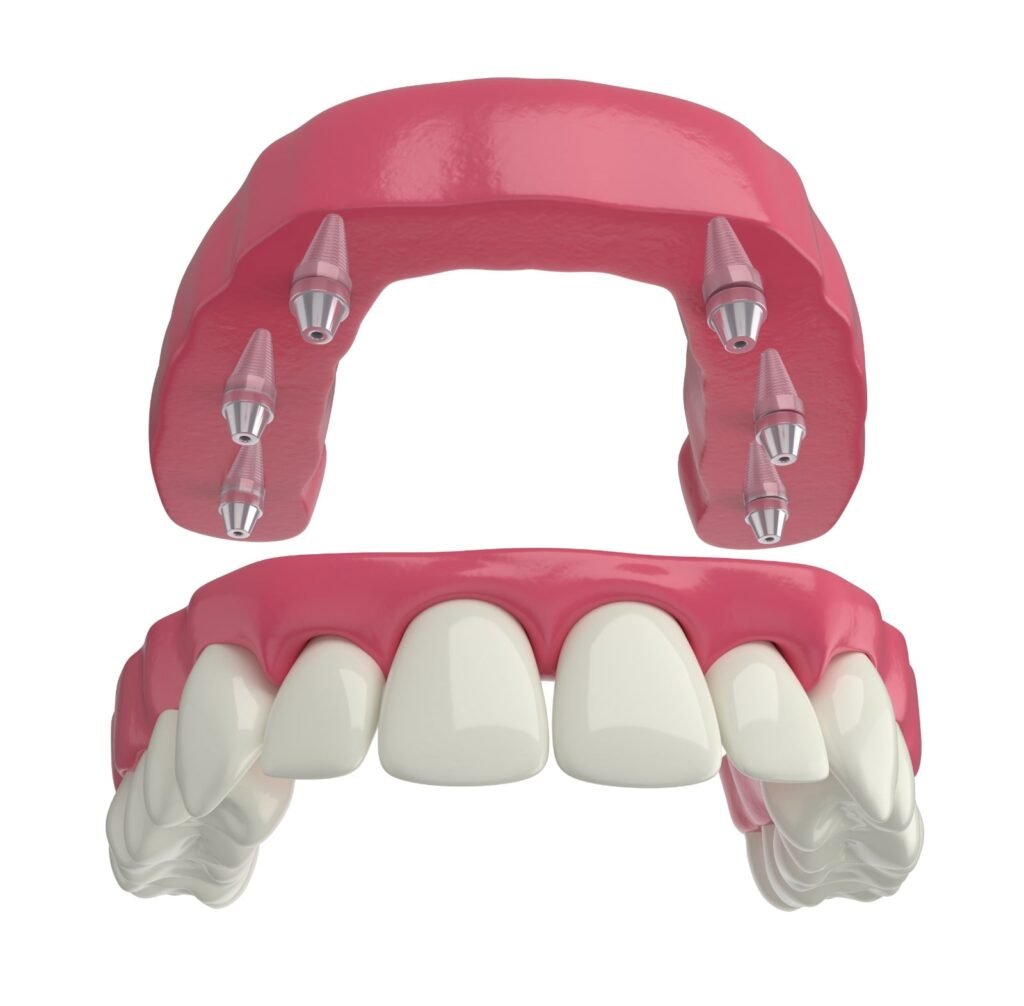 Dental Implant Cost In India Types Advantages Etc