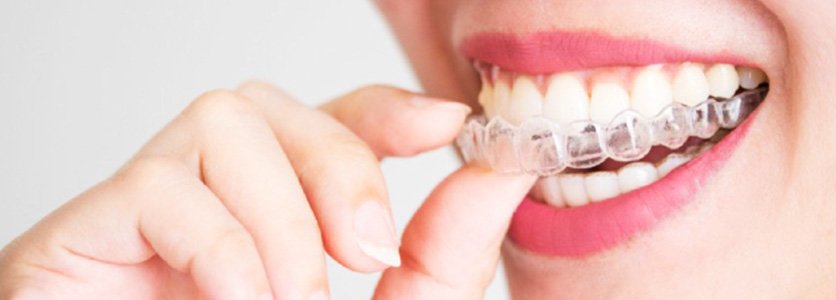 best invisible aligners for teeth