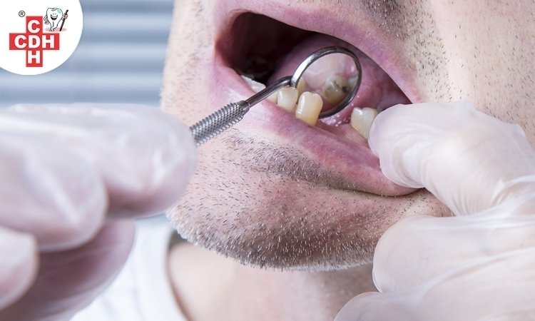 Know how missing teeth can hurt your oral health