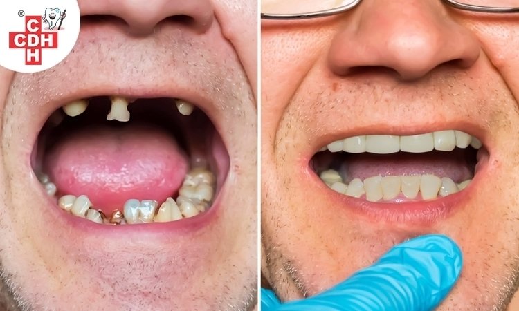 Are dental implants safe?
