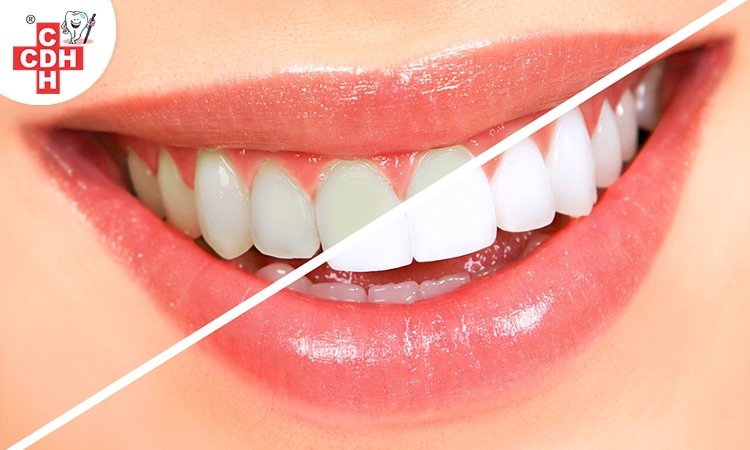 Effects of teeth whitening