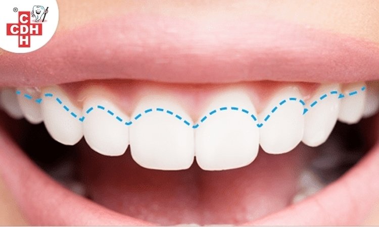 How to fix receding gums?