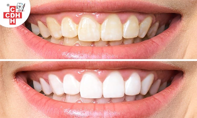 5 most successful procedure included in a smile makeover