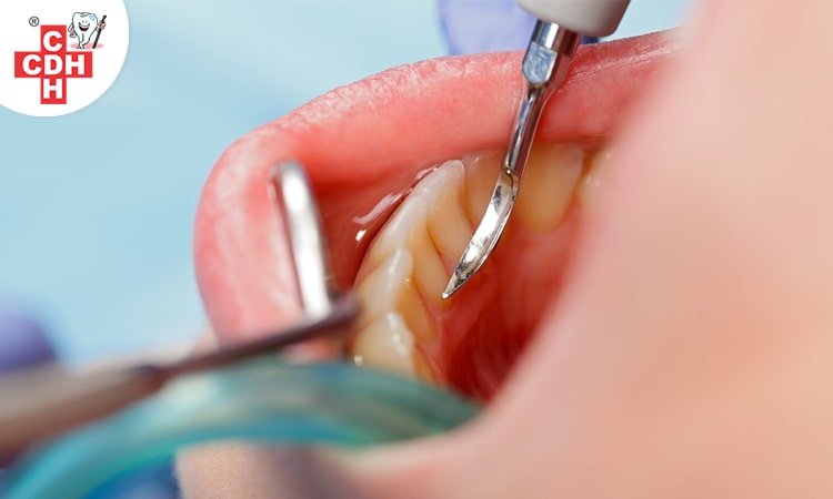 How much can dental scaling be fruitful