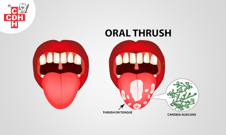 Oral Thrush - Everything you need to know - #1 CDH