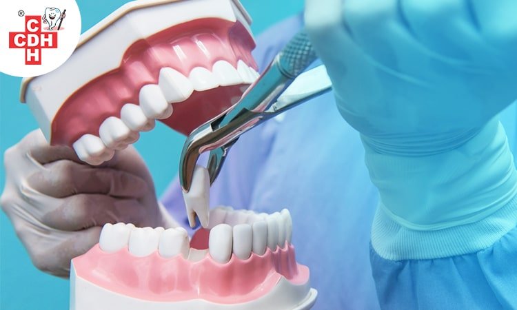 5 reasons why you should extract your wisdom teeth