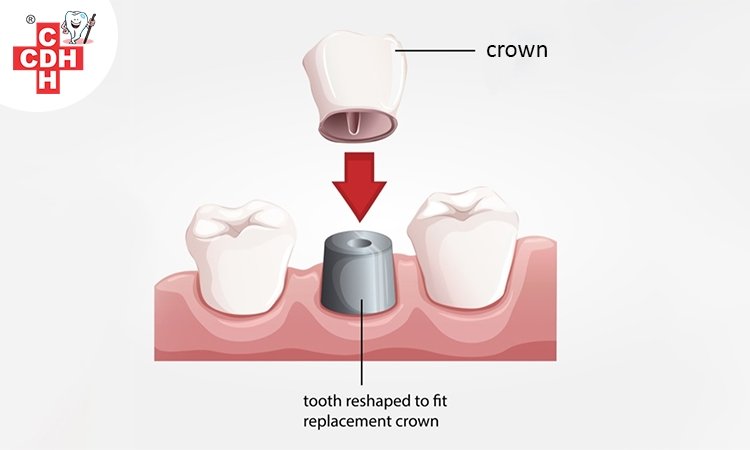 Dental Crowns