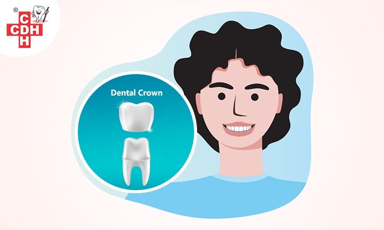 Dental crowns