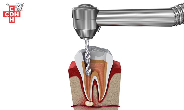 root canal treatment in rajkot