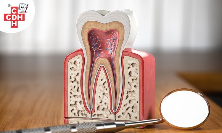 Treating Root Canal at home