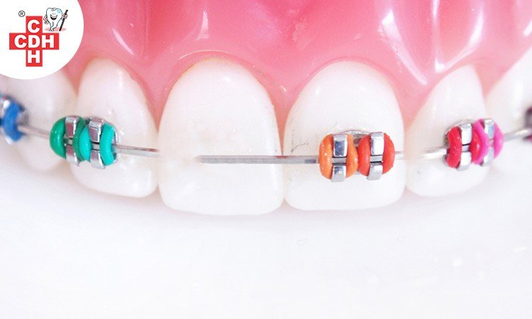 Loose or Broken Orthodontics