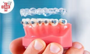 How to choose right braces clear aligners or metal braces