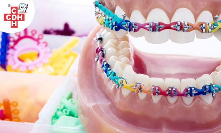 braces treatment in gujarat