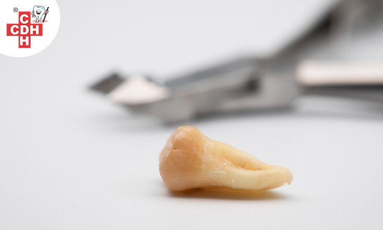 wisdom tooth removal in rajkot