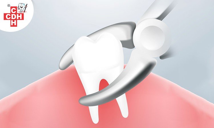 Tooth extraction causes procedures and aftercare