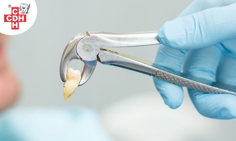 What is a Tooth Extraction