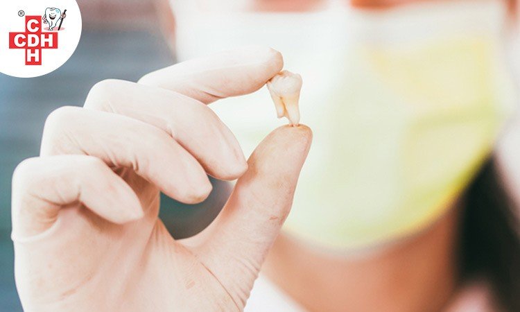 Causes of Tooth Extraction
