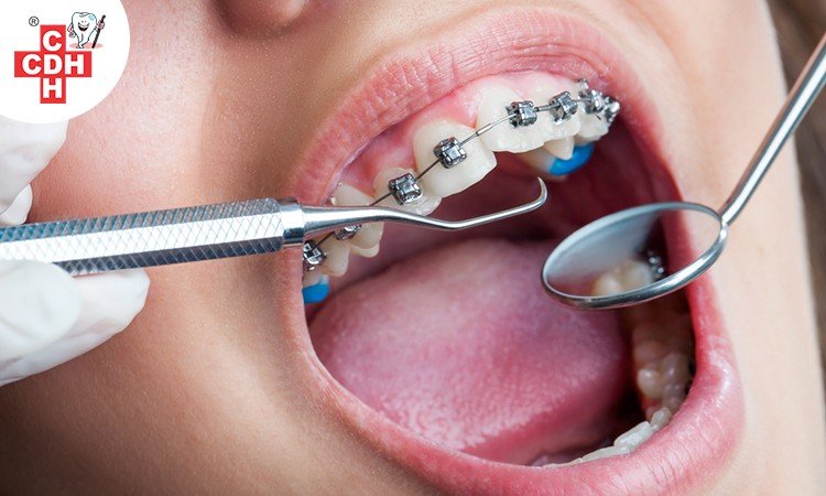 Dental Braces: Treatment and Options - #1 CDH
