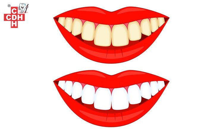 Reasons your teeth become discoloured
