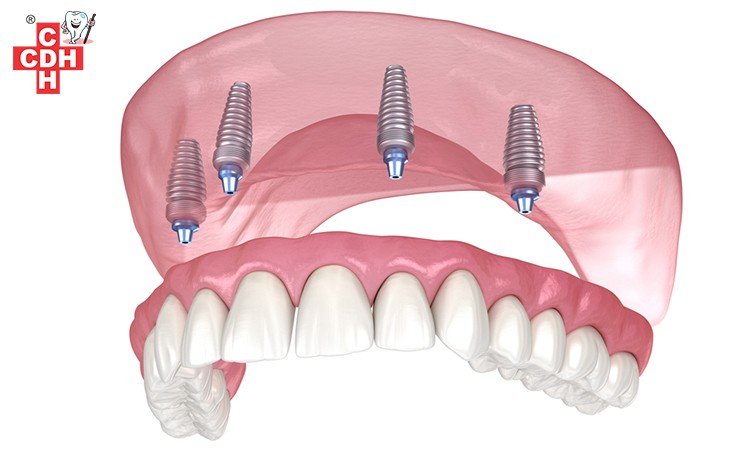 What are Implant-Supported Dentures