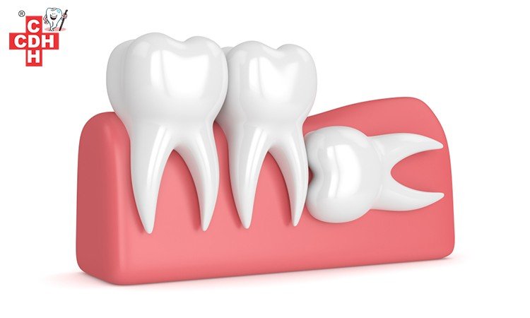 wisdom tooth removal in gujarat