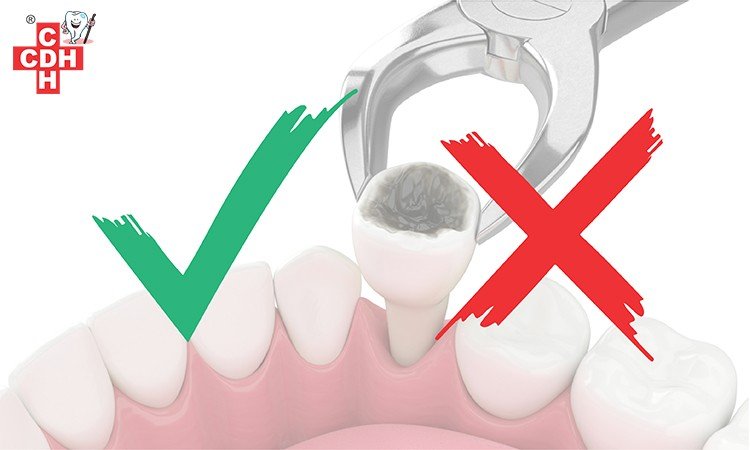 Dos and donts after tooth extraction