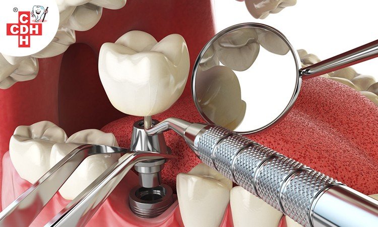 How much time does the dental implant treatment take