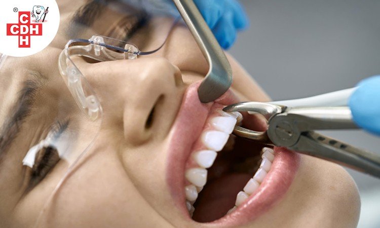 What is Tooth Extraction