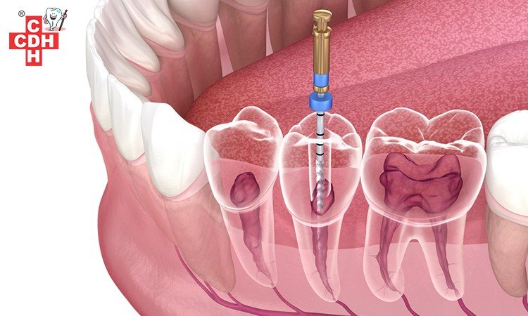 Myths and Facts of Root Canal Treatment