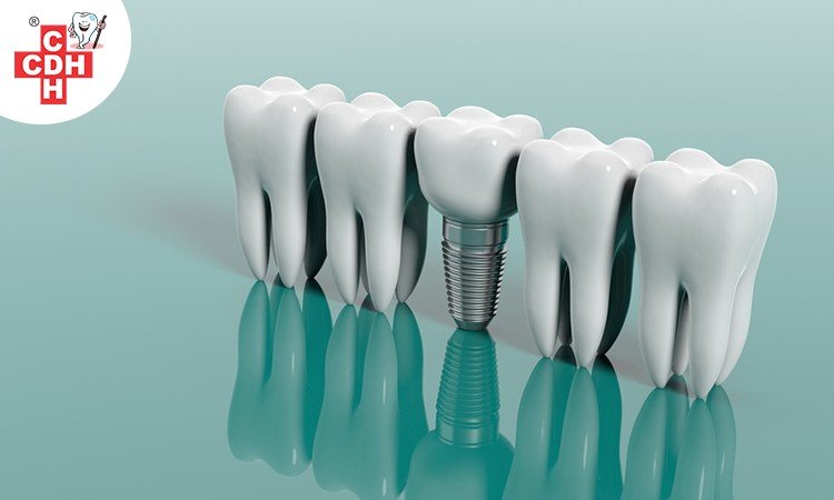 Cost of Dental Implants