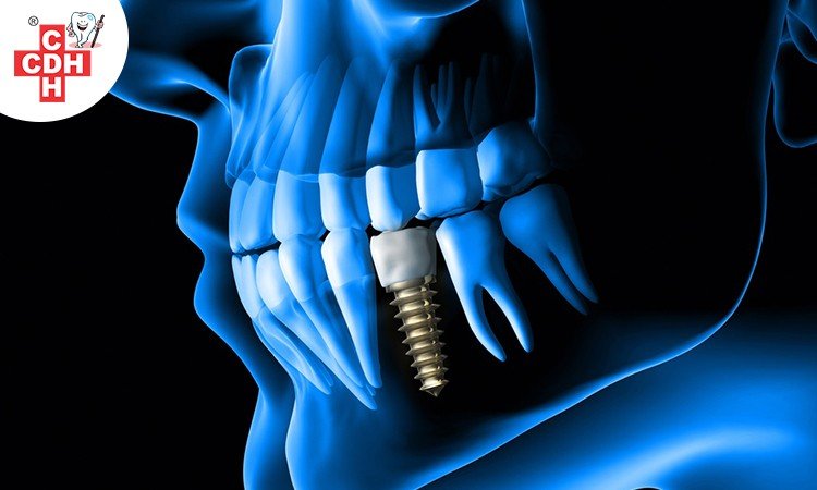 What is Dental Implants