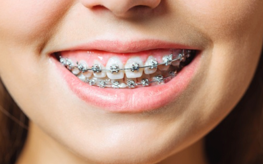 Braces Cost In India | Teeth Braces Price in India