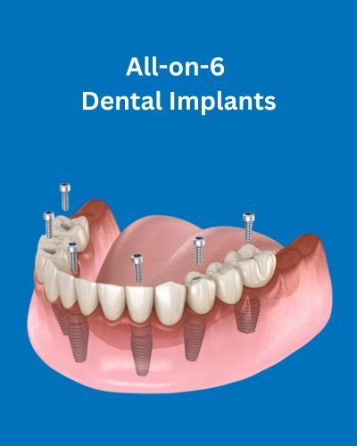 all on 6 dental implants in india