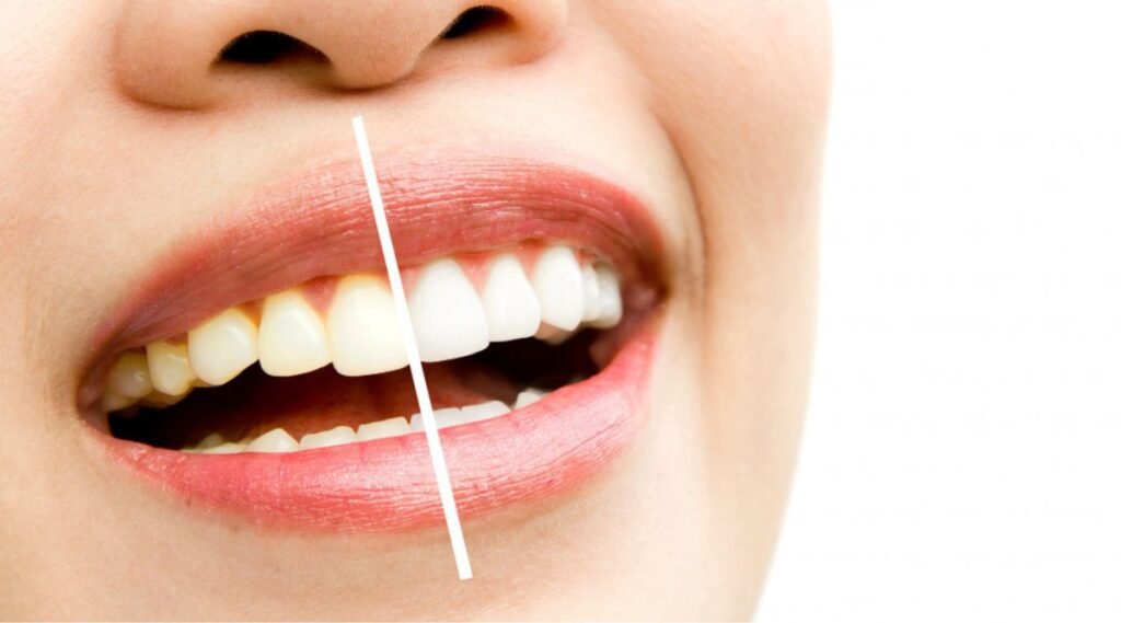 Teeth Whitening treatment done successfully in Dental Tourism in India from City Dental Hospital